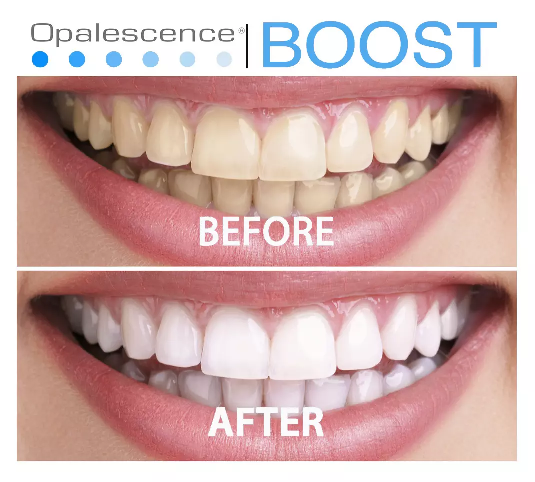 Отбеливание Opalescence boost+профгигиена в подарок!!!